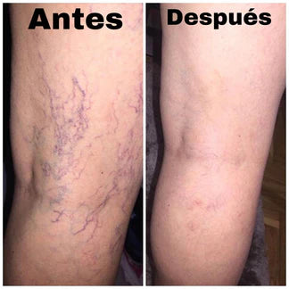 SPARY ANTI-VARICES™ ⭐⭐⭐⭐⭐ Elimina las arañitas de tus piernas